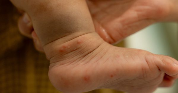 Đầu năm học, cảnh báo gia tăng bệnh ở trẻ nhỏ