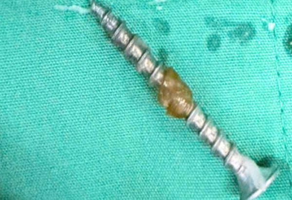 Đinh vít sắc nhọn nằm trong bụng bé gái 30 tháng tuổi