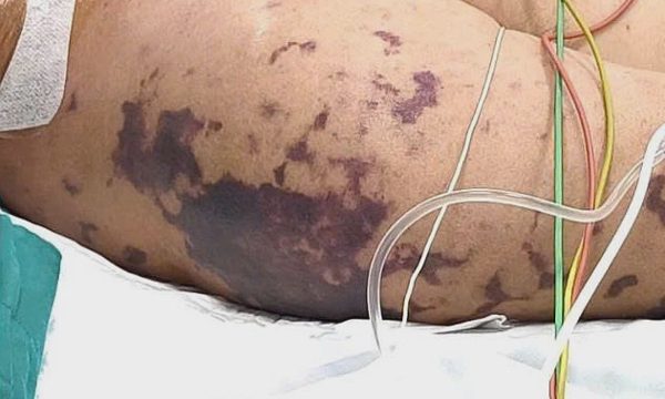 Độc tố não mô cầu gây hoại tử như thế nào?