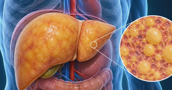 Gan nhiễm mỡ có thể dẫn đến ung thư gan không?