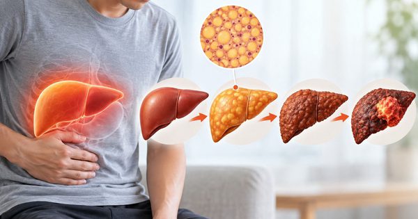 Gan nhiễm mỡ: Khi nào nguy cơ ung thư gan tăng cao?