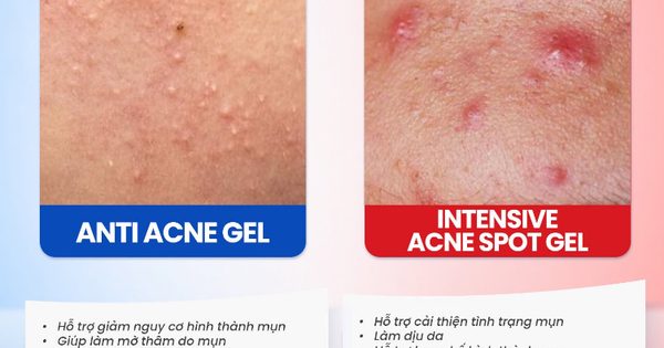Gel chấm mụn Trioderma hiệu quả với loại mụn nào mà giới skincare đua nhau tìm mua?