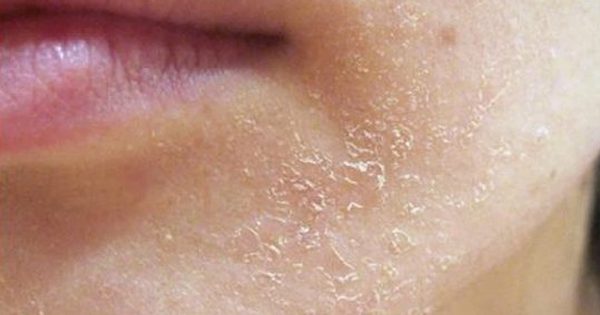 Giải mã lotion dưỡng ẩm, kiềm dầu cho da mụn nhạy cảm đang được chú ý