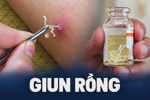 Giun rồng “tái xuất” ở Việt Nam, giới khoa học đau đầu nhận dạng