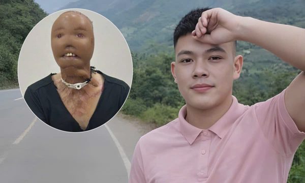 Hành trình tìm lại diện mạo của chàng trai mất mặt vì nước sôi
