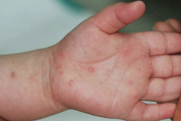 Hơn 40.000 ca tay chân miệng tại TPHCM, bác sĩ cảnh báo dấu hiệu nặng