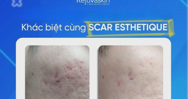 Kem mờ sẹo rỗ nào hiệu quả với cả sẹo lâu năm mà không cần xâm lấn?