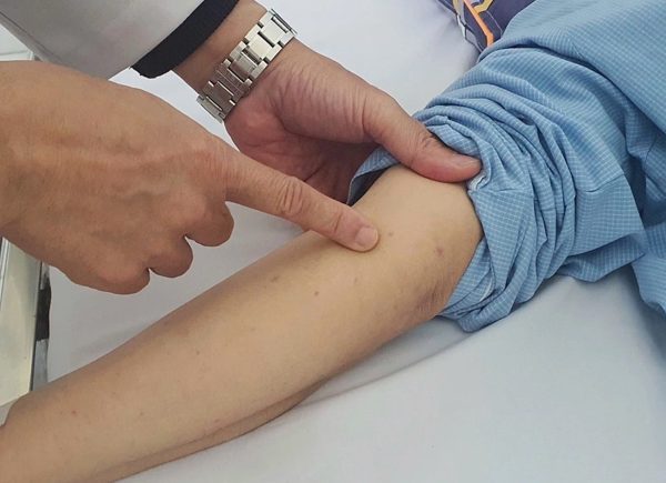 Khoảng trống miễn dịch khiến thanh thiếu niên dễ mắc não mô cầu