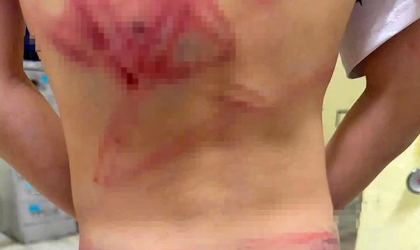 Không khởi tố cha đánh con trai 9 tuổi bầm tím khắp người ở Quảng Trị