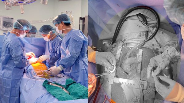 Lần đầu tiên tại Việt Nam cấy ghép thành công thiết bị hỗ trợ tim CorHeart 6