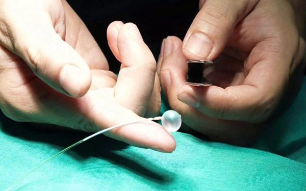 Lần đầu tiên tại Việt Nam: Đặt bóng vào khí quản thai nhi 30 tuần tuổi, cứu trẻ từ trong bụng mẹ