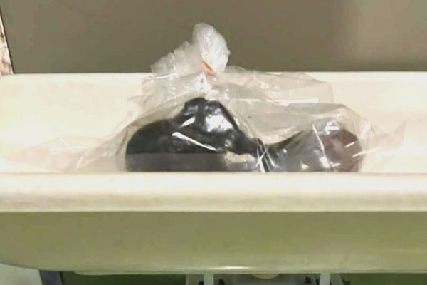 Lấy khối tóc 0,25kg trong đường tiêu hóa của bé gái 5 tuổi