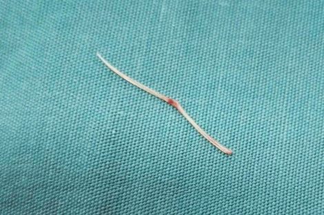 Lấy xương cá dài 3cm xuyên từ đại tràng vào gan của người đàn ông ở Cà Mau