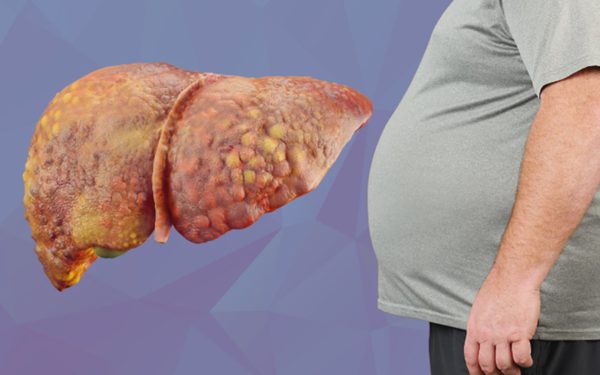 Loại thực phẩm đưa bạn đến gần hơn với bệnh gan nhiễm mỡ