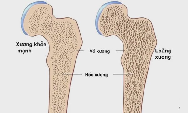 Loãng xương - mối nguy âm thầm rình rập phụ nữ sau tuổi 40