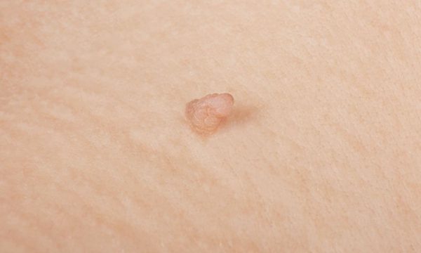 Mắc sùi mào gà ở lưỡi