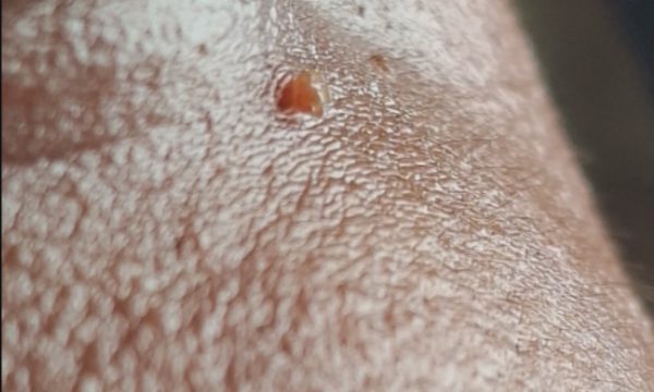 Mắc sùi mào gà ở mí mắt