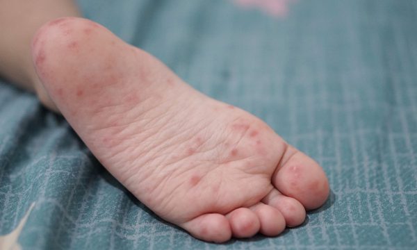 Mắc tay chân miệng lần hai có nhẹ hơn lần đầu?