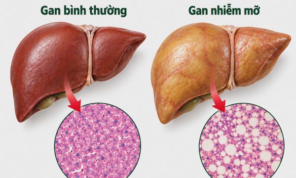 Men gan bình thường là dấu hiệu gan khỏe?