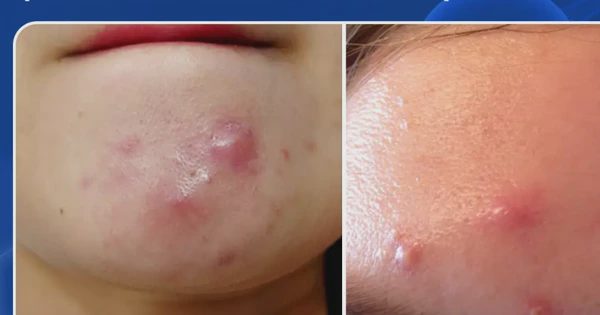 Mụn sưng đỏ không nhân: Càng muốn nặn càng dễ thâm, chấm mụn thế nào mới đúng?