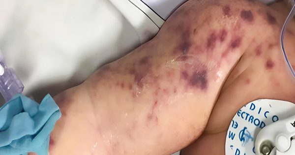 Não mô cầu: Ban xuất huyết xuất hiện ở giai đoạn nào của bệnh?