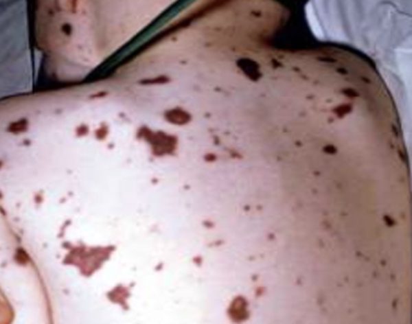 Não mô cầu có thể gây tử vong trong 24 giờ, bác sĩ chỉ triệu chứng cần cảnh giác