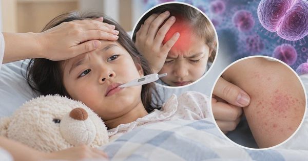 Não mô cầu: Khi nào cần cảnh giác với sốt, đau đầu, phát ban?