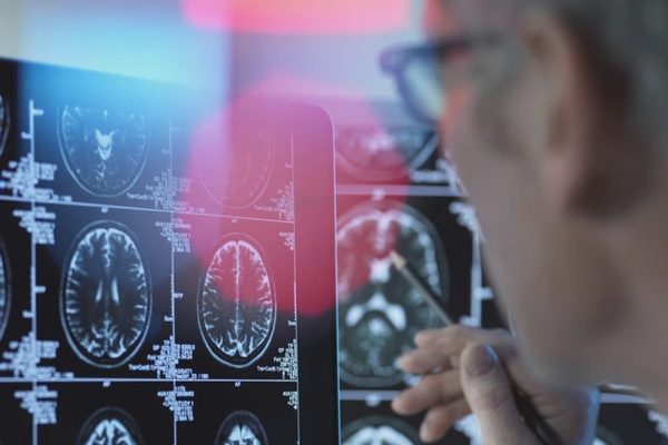 Nga thành công thử nghiệm sơ bộ chiến lược mới điều trị bệnh Alzheimer
