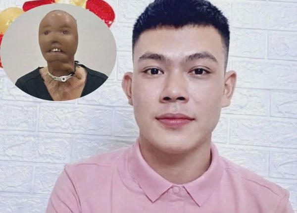 Nghị lực của chàng trai mất mặt vì bỏng nước sôi
