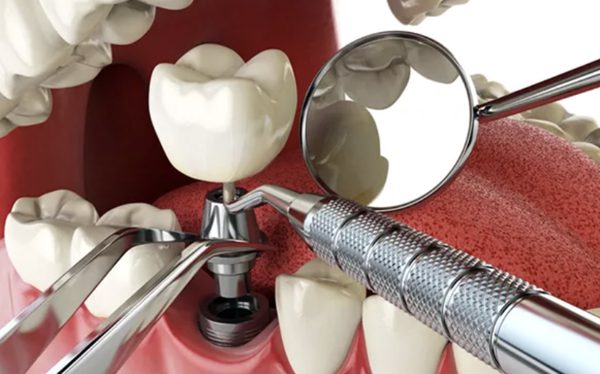 Người bệnh đái tháo đường có nên cấy implant ngay sau khi nhổ răng?