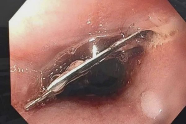 Người bệnh đau họng khi ăn mì tôm, bác sĩ phát hiện dao lam trong thực quản
