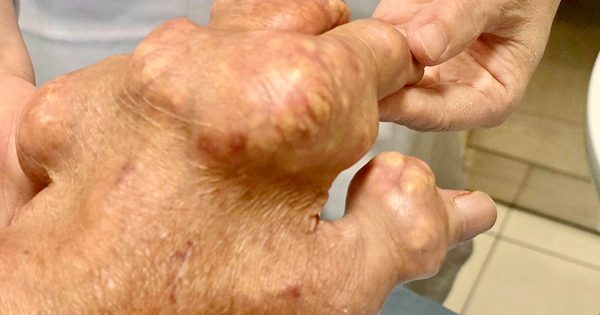Người bị gout có nên ăn ức gà thay thế hoàn toàn thịt lợn, bò?