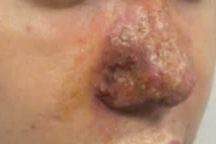 Người đàn ông 40 tuổi hoại tử mũi sau tiêm filler tại spa