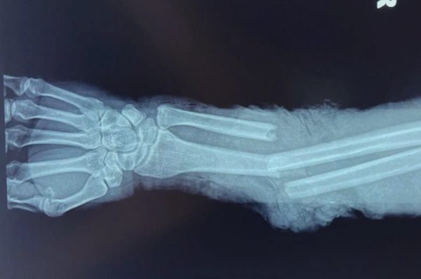 Người đàn ông ở Lâm Đồng bị máy nghiền đá cuốn đứt cẳng tay