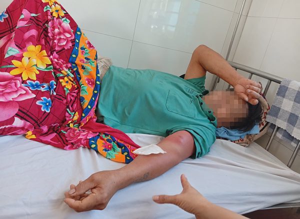 Người đàn ông ở Thanh Hóa mắc bệnh giun rồng do uống nước suối