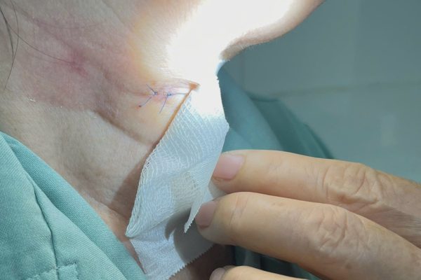 Người phụ nữ ở TPHCM nguy kịch sau mắc sốt xuất huyết, đường thở bị bít kín