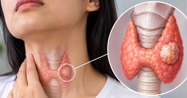 Người trẻ cũng mắc ung thư tuyến giáp: 4 yếu tố nguy cơ cần biết