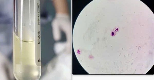 Nhận biết triệu chứng nghi não mô cầu sau tiếp xúc ca bệnh
