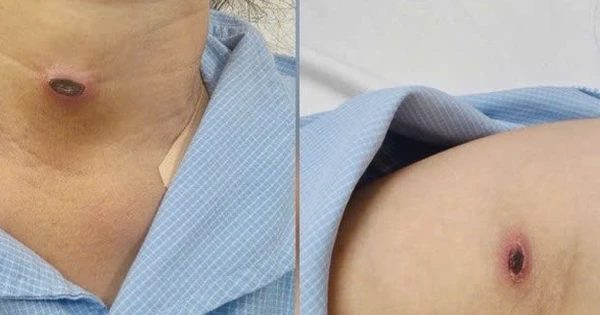 Nhận diện bệnh sốt mò