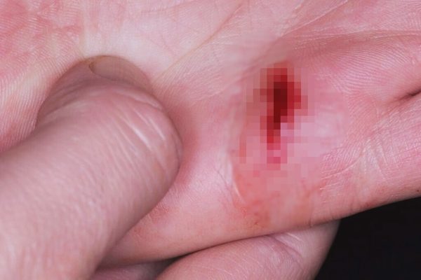 Nhiễm uốn ván, bé trai 7 tuổi ở TPHCM liên tục gồng cứng, co giật nguy kịch