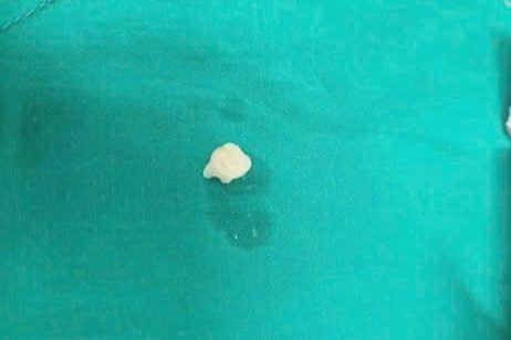 Nhổ răng tại nhà bằng sợi chỉ, bé trai 7 tuổi nuốt luôn chiếc răng cửa