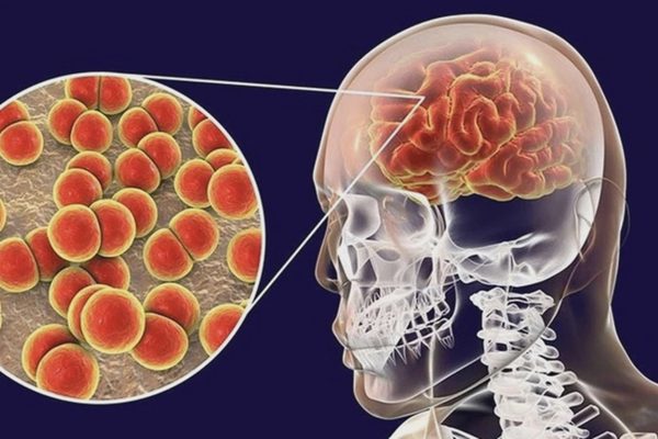 Những điều cần biết về vi khuẩn gây viêm não mô cầu