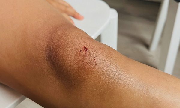 Những vết thương nhỏ tiềm ẩn nguy cơ nhiễm trùng