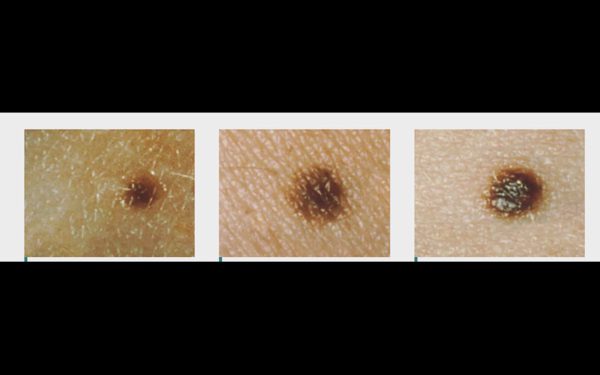 Nốt ruồi: 5 dấu hiệu cảnh báo ung thư da không nên bỏ qua