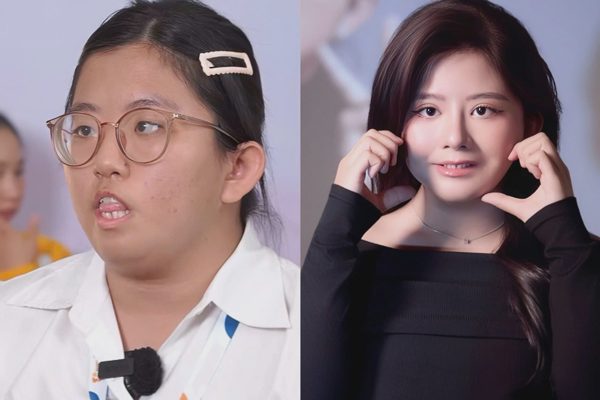 Nữ sinh từng bị gọi là “quái vật” và 3 cuộc đại phẫu tìm lại nụ cười
