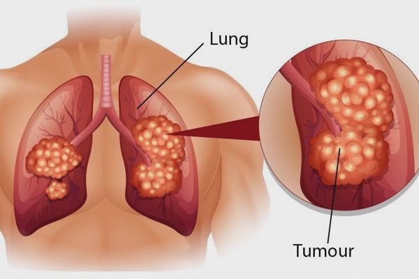 Phần lớn người mắc ung thư phổi được phát hiện ở giai đoạn muộn