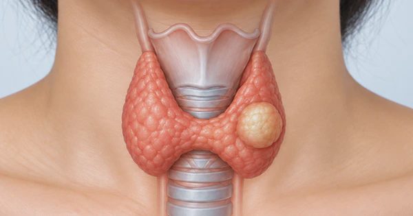 Phát hiện nhân tuyến giáp có phải là ung thư?