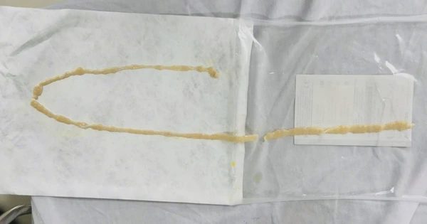Phát hiện sán dài 70 cm sống trong ruột, dù không có bệnh tiêu hóa