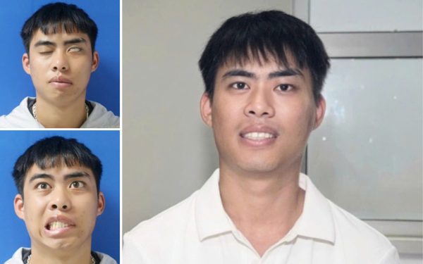 Phục hồi thành công gương mặt cho nam thanh niên liệt mặt suốt 7 năm