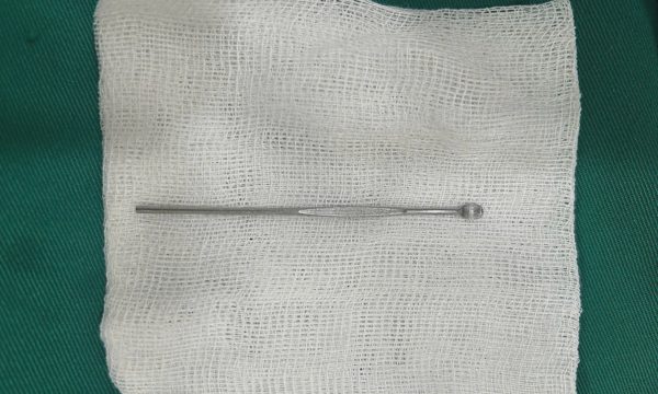 Que ráy tai 12 cm kẹt trong niệu đạo bé trai 14 tuổi